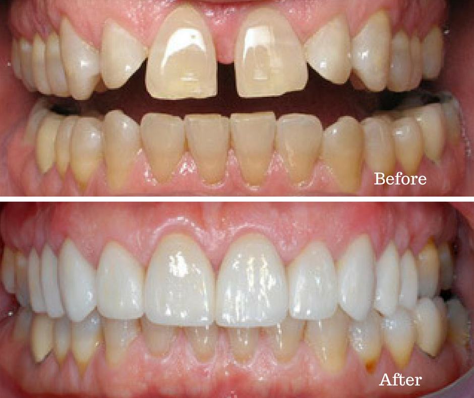 Before and After Teeth Whitening